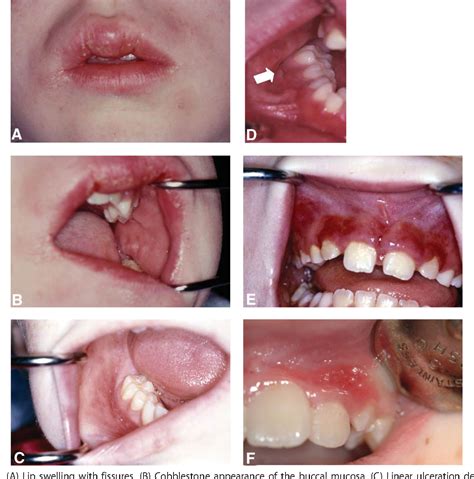 Figure 1 From Looking In The Mouth For Crohn S Disease Semantic Scholar