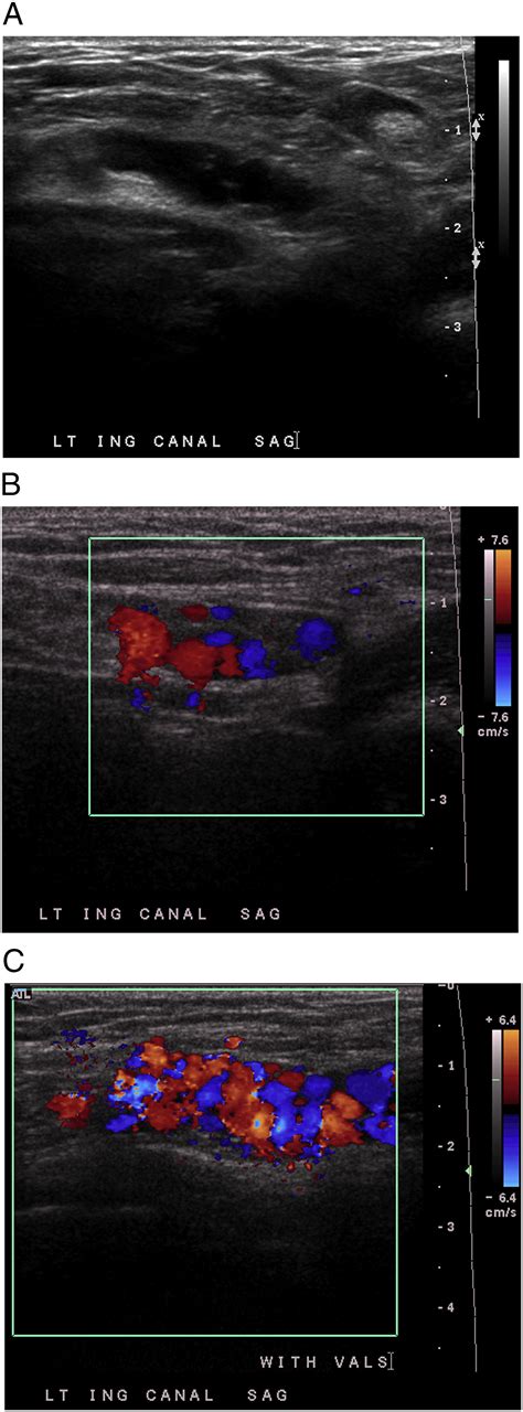 Anatomy and pathology of the canal of Nuck - Clinical Imaging