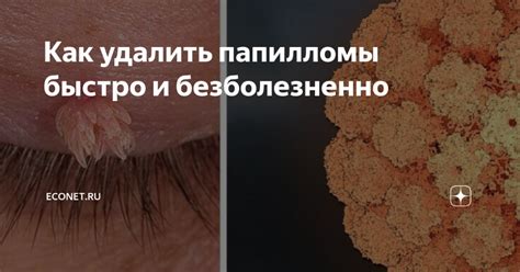 Как удалить папилломы быстро и безболезненно | Медицина, Здоровый