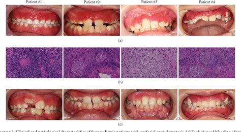 Figure From Orofacial Granulomatosis Among Pediatric Patients Well