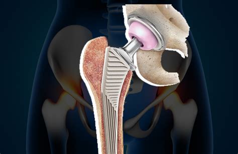 Revision Total Hip Replacement