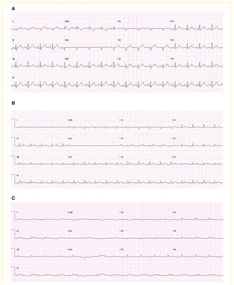 Electrocardiograms A Electrocardiogram On Admission Demonstrating