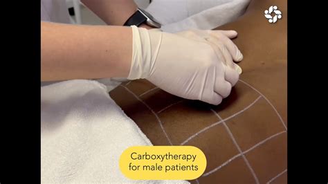 Carboxytherapy And Rid For Abnormal Resistant Fat Youtube