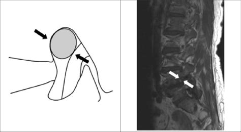 Degree 1 Of Foraminal Stenosis The Diagram Shows The Obliteration Of