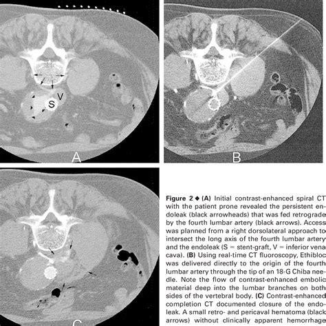 Figure 2 From CT Guided Percutaneous Embolization Of A Lumbar Artery