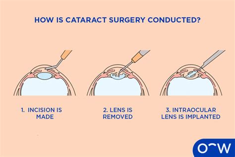 Cataract Surgery How Is Surgery Conducted Complications And Recovery Time