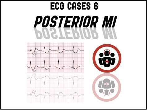 Posterior Wall Mi Ecg Changes