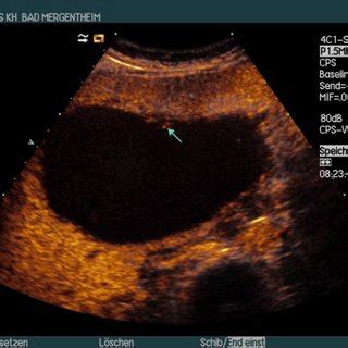 B Mode Imaging A And Contrast Enhanced Ultrasound Ceus B In A