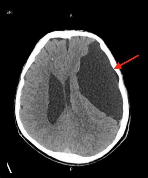 Initial Ct Head Scan Showing A Large Csf Density Extra Axial Cystic