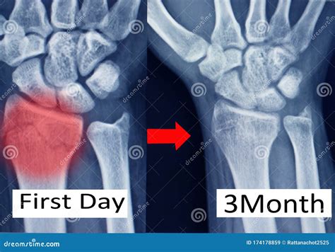 Distal Radius Fracture X Ray