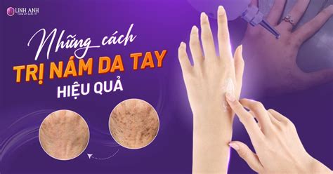 nam da tay la gi  cach dieu tri nam da tay tai nha