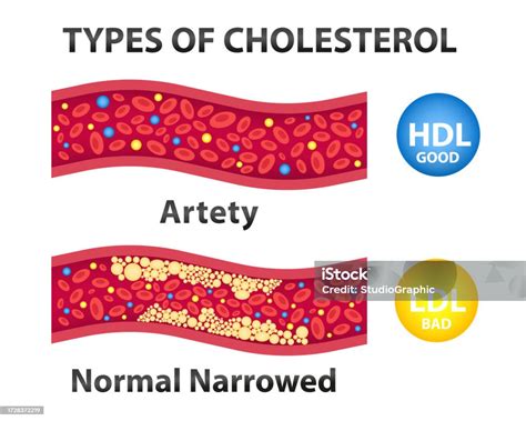 Types Of Cholesterol Comparison With Hdl And Ldl Lipoprotein Labeled