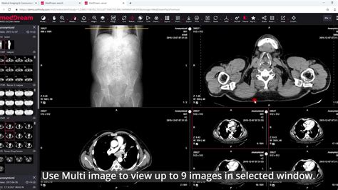 Meddream Dicom Viewer The Multi Image View Youtube