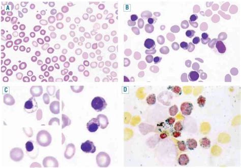 Sideroblastic Anemia Cancer Therapy Advisor