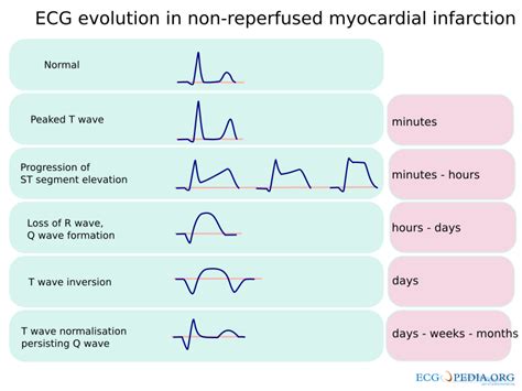 Bestand Mi Evolution Svg Ecgpedia