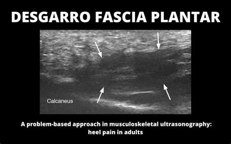 Fascia Plantar Ecografía Aprende a valorarla Tempo Formación