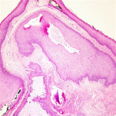 Intraoperative View Of The Uvula Mass After Placement Of Crowe Davis