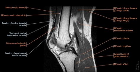 Joelho Irm Atlas Da Anatomia Em Imagens Médicas E Anatomy