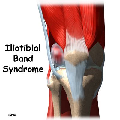 Iliotibial Band Syndrome Orthopedic Surgery Algonquin Il