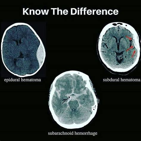 Epidural Hematoma Vs Subdural Hematoma Vs Subarachnoid Medizzy