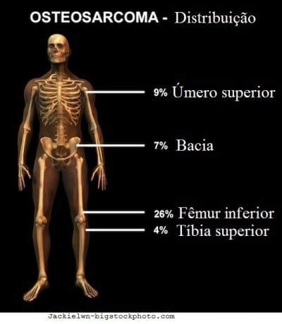 C Ncer Sseo Sintomas Met Stase E Tratamento