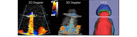 Doppler And Simulated Proximal Isovelocity Surface Area PISA Images