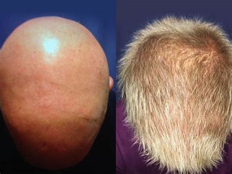 FDA-Approved Drug Cured Patients with Alopecia Areata