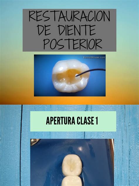 Restauracion de Diente Posterior | PDF