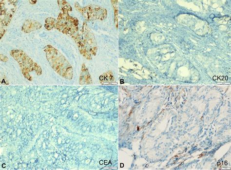 Photomicrograph Of The Tumor Showing IHC Profile A Strong