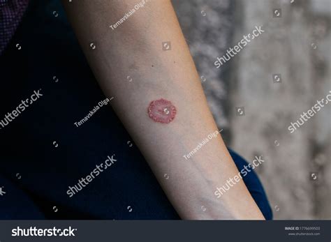 149 Skin Infection Erysipelas Images Stock Photos And Vectors Shutterstock