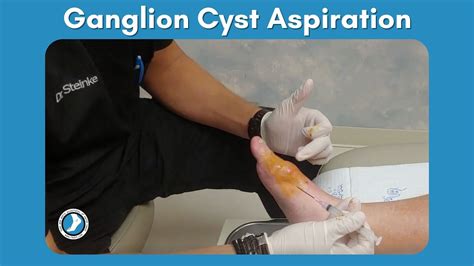 Ganglion Cyst Aspiration Youtube