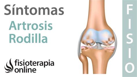 C Mo Entender Y Minimizar Los S Ntomas De La Artrosis De Rodilla