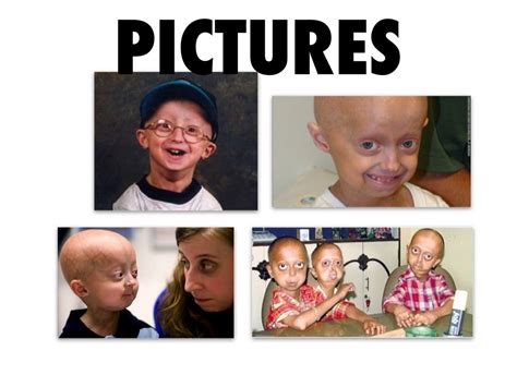 Progeria Slide By Ismah Khan