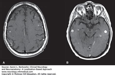 Neoplastic And Paraneoplastic Disorders Of The Nervous System And Neurologic Complications Of