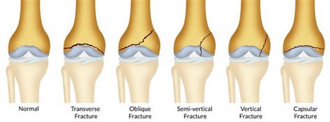 The most common knee injuries and disorders – Orthomen