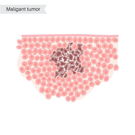 Vector ilustración aislada de tumor maligno en tejido sano propagación