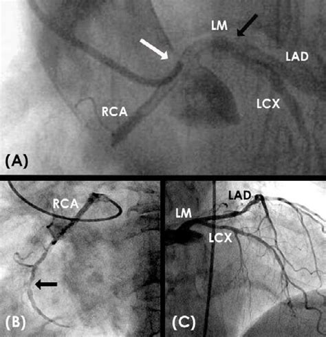 Variant Of Right Coronary Ostium Athis Is The Angiogram Of The