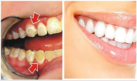 Be Your Own Dentist See How To Remove Plaque From Your Teeth In Just 5