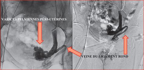 JLE Sang Thrombose Vaisseaux Varices vulvo périnéales et veine du