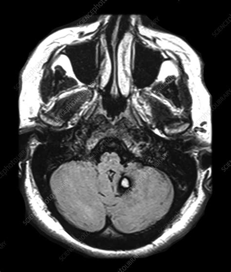 Mri Dva And Cavernous Malformation Stock Image C0432802 Science