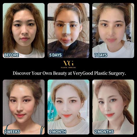 Vietnamese Plastic Surgery Before And After Before And After