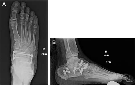 Triple Arthrodesis Foot And Ankle Clinics