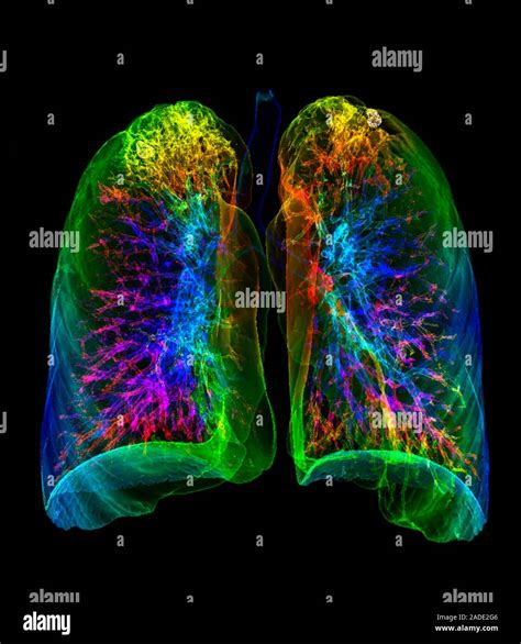 Pulmonary Tuberculosis Coloured Frontal 3D Computed Tomography CT