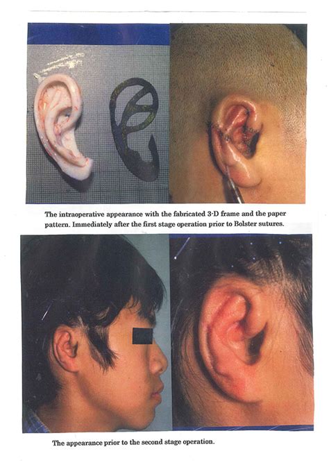 Auricular Reconstruction Following ENT SurgeryNagata Microtia And