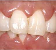 Gingival Hyperplasia - Symptoms of Hyperplasia, Treatment of Gingival ...