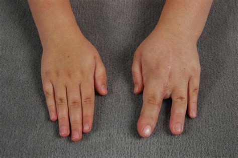 Macrodactyly- Big fingers | Congenital Hand and Arm Differences