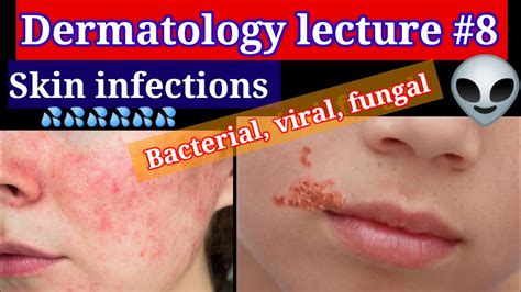 Skin Infections Dermatology Lecture 8 Bacterial Viral Fungal Skin