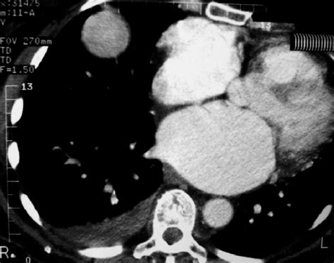 Initial Axial Contrast Material Enhanced Ct Demonstrates The Cm