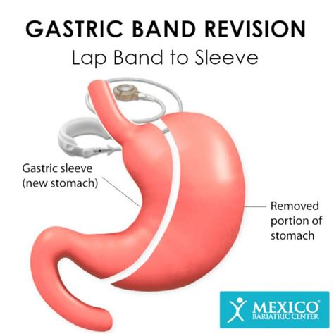 Lap-Band Revision Surgery in Mexico - Mexico Bariatric Center