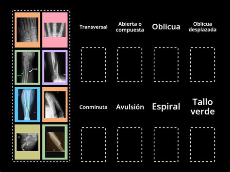 Tipos De Fracturas Ordenar Por Grupo